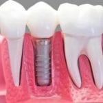 Dental Implant Spokane WA